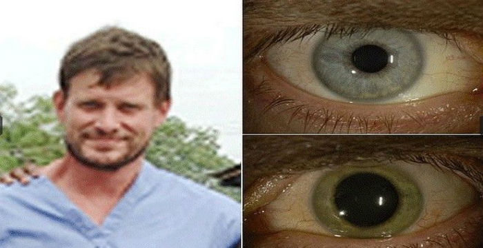 eye1