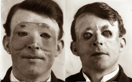 plastic-surgery_Walter-1-Yeo
